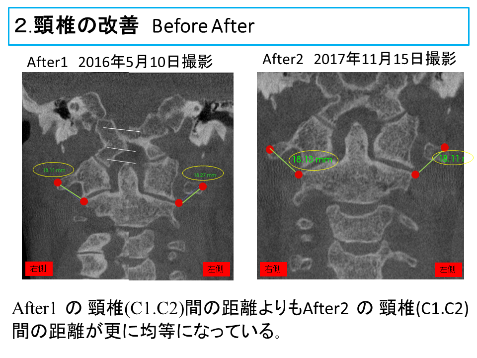 横浜市中区の歯科・歯医者 横浜山手デンタルクリニックTALK画像　頸椎の改善治療前と治療後