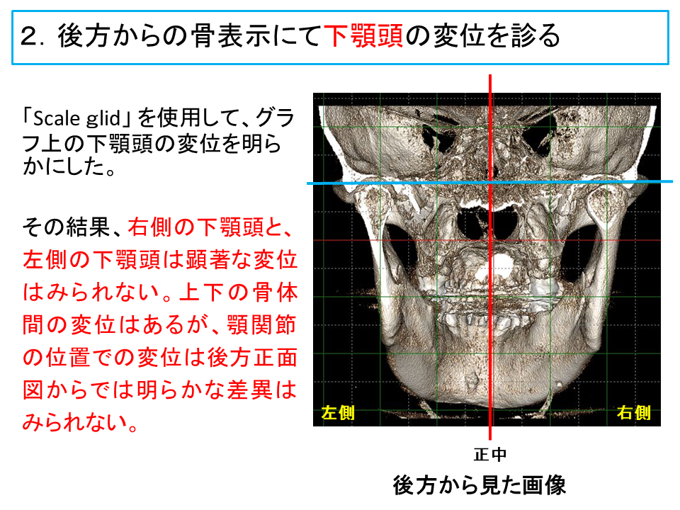横浜市中区の歯科・歯医者 横浜山手デンタルクリニックTALK画像　後方から見た下アゴの変異