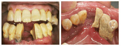 横浜の歯科・歯医者 横浜山手デンタルクリニック 歯周病の患者さんの歯