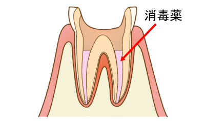 横浜の歯科・歯医者 横浜山手デンタルクリニック 神経の治療