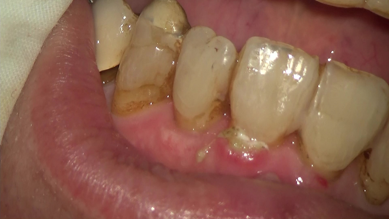横浜の歯科・歯医者の横浜山手デンタルクリニック 歯肉退縮治療 Before