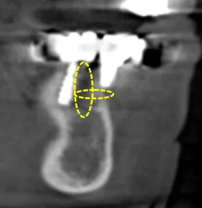 撮影した3次元CT写真 骨の欠損が確認できる 2次元口腔内パノラマ写真 横浜市中区山手町の歯医者・歯科 横浜山手デンタルクリニック