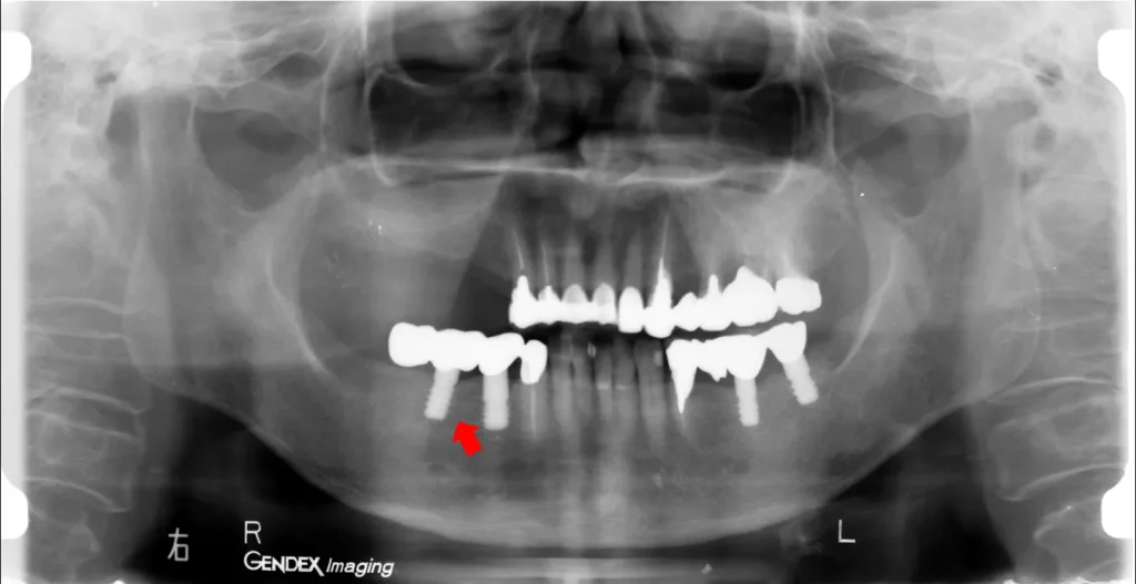インプラント周囲炎の患者さんの2次元デンタルパノラマ写真 横浜市中区山手町の歯医者・歯科 横浜山手デンタルクリニック