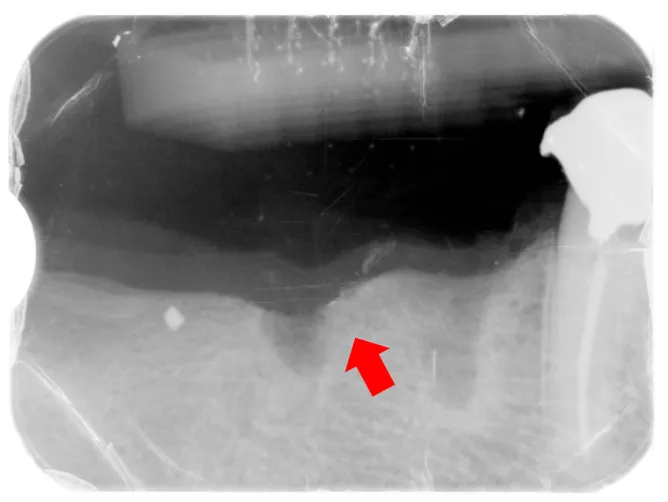 インプラント周囲炎術後写真 インプラント除去 横浜市中区山手町の歯医者・歯科 横浜山手デンタルクリニック