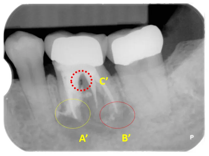 歯根端切除術、MTAによる逆根充同時の並行治療症例 術後 横浜の歯科・歯医者 横浜山手デンタルクリニック