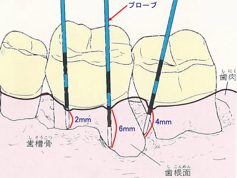 横浜の歯科・歯医者 横浜山手デンタルクリニック 歯と歯肉の間からプローブ（検針）を入れて探る