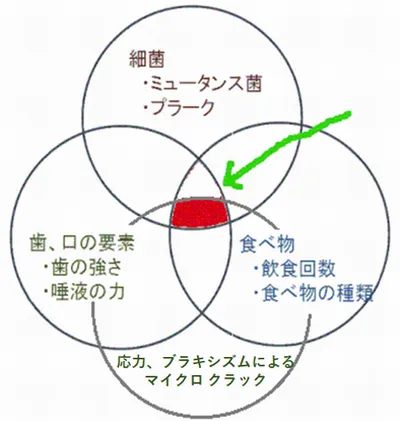 横浜市中区の歯科・歯医者 横浜山手デンタルクリニック　Paul Keysの齲蝕論 新しい虫歯発症の原因