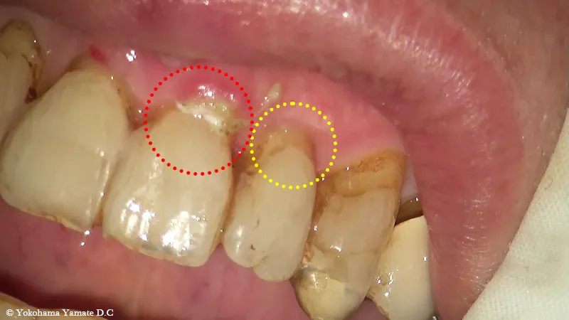 歯肉退縮治療 治療前 横浜の歯科・歯医者の横浜山手デンタルクリニック