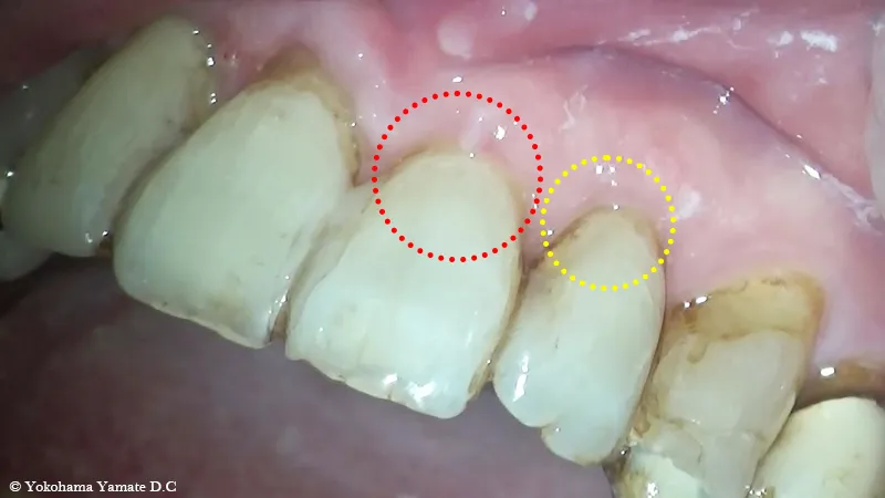 歯肉退縮治療 治療後 横浜の歯科・歯医者の横浜山手デンタルクリニック