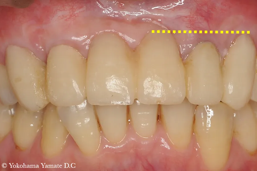 歯肉（上皮下結合組織）の移植術 治療前 横浜の歯科・歯医者の横浜山手デンタルクリニック