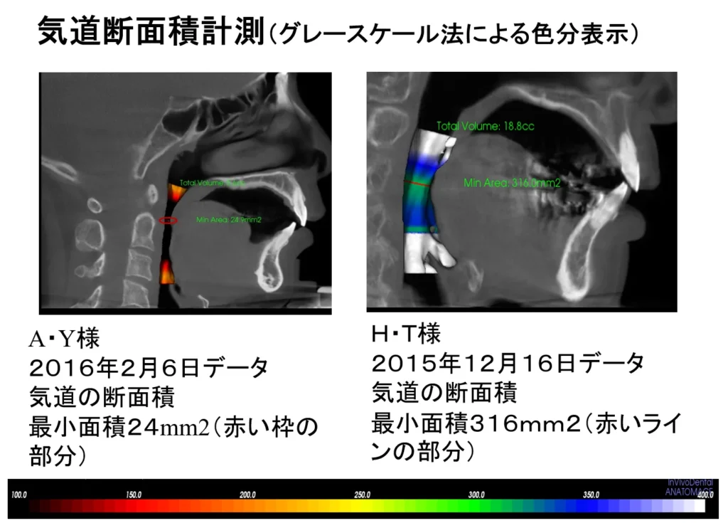 歯科治療による気道の拡張 気道断面積計測  横浜の歯科・歯医者 横浜山手デンタルクリニック