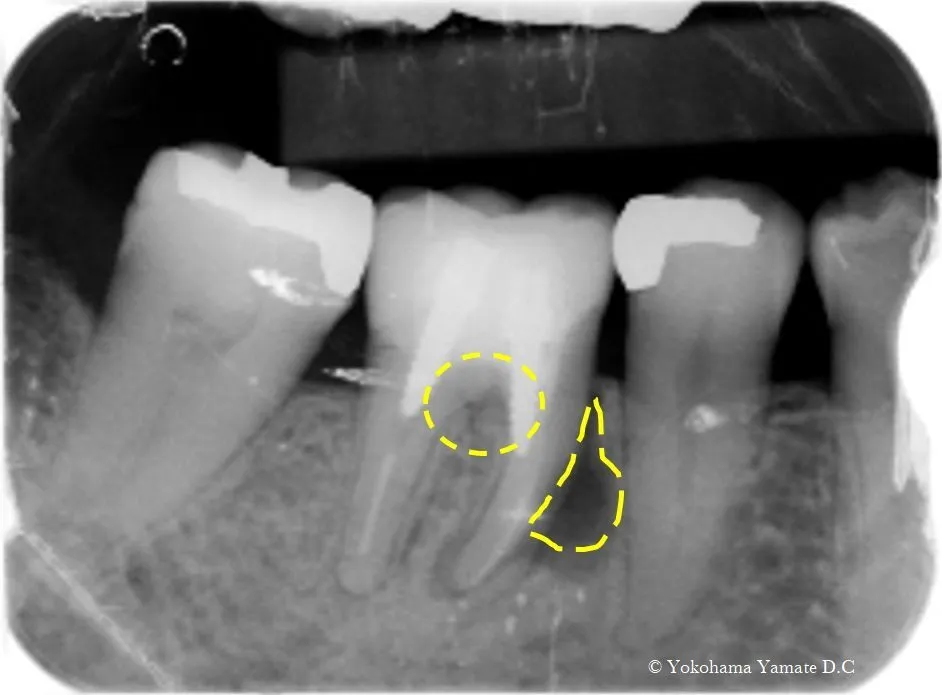 抜かないで残す歯周病除菌治療 横浜の歯科・歯医者 横浜山手デンタルクリニック