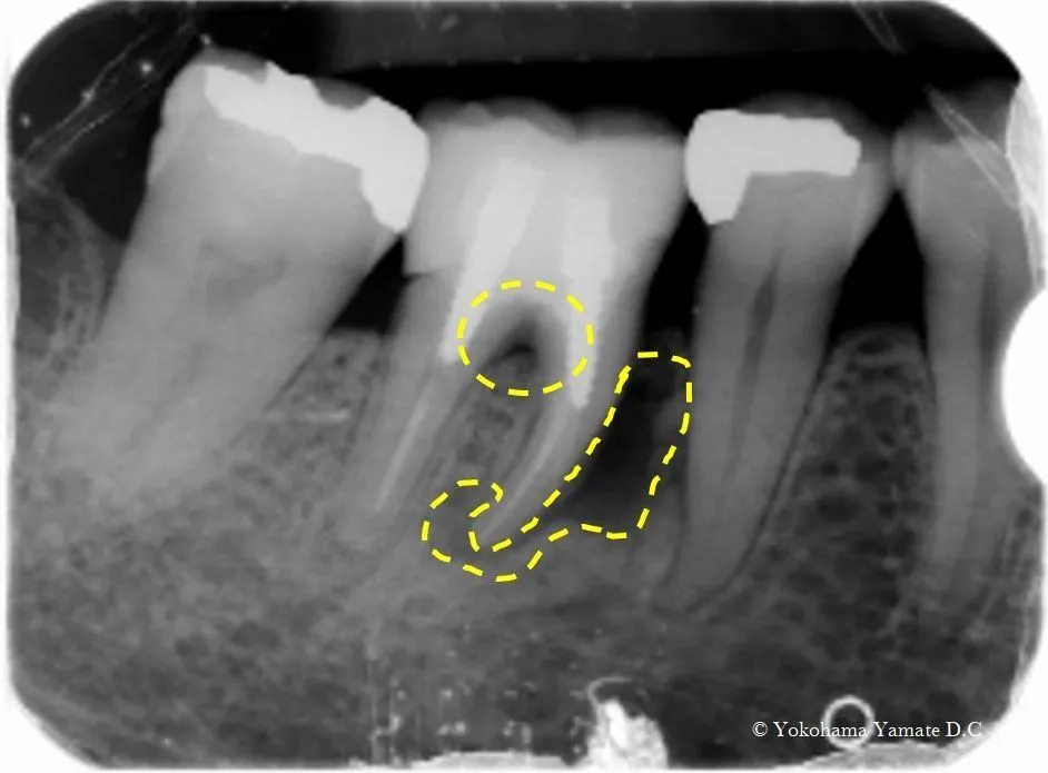 抜かないで残す歯周病除菌治療 横浜の歯科・歯医者 横浜山手デンタルクリニック