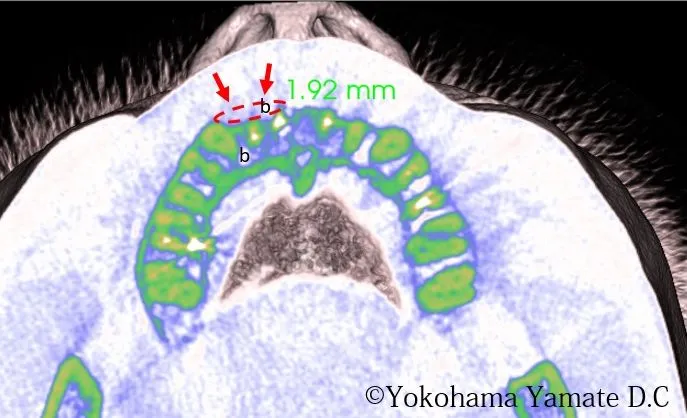 インプラント治療 インプラント周囲の歯肉や骨の増生（術前） 横浜市中区山手町の歯医者・歯科 横浜山手デンタルクリニック