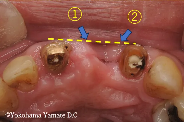 歯肉や骨の再生とインプラント治療 横浜の歯科・歯医者 横浜山手デンタルクリニック