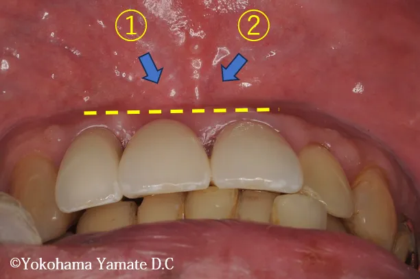歯肉や骨の再生とインプラント治療 横浜の歯科・歯医者 横浜山手デンタルクリニック