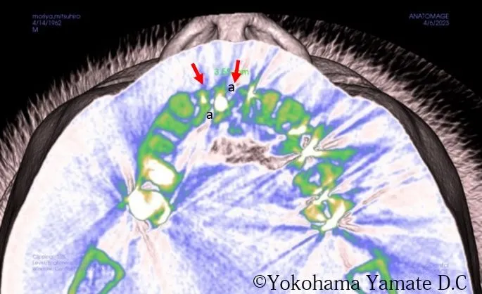 インプラント治療 インプラント周囲の歯肉や骨の増生（術後） 横浜市中区山手町の歯医者・歯科 横浜山手デンタルクリニック
