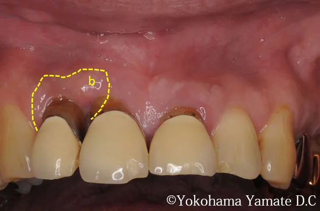 歯肉や骨の再生とインプラント治療術前写真 横浜の歯科・歯医者 横浜山手デンタルクリニック