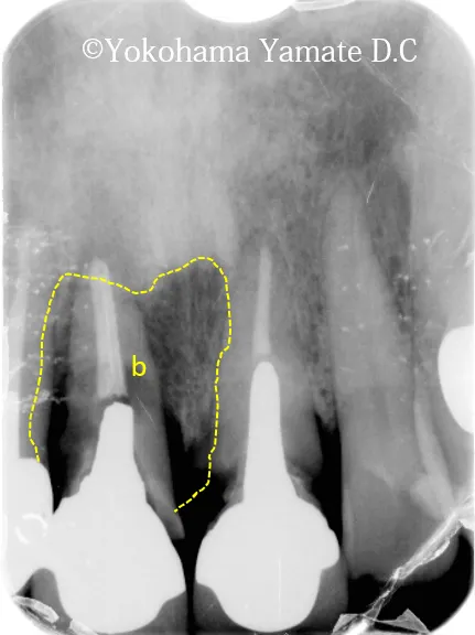 歯肉や骨の再生とインプラント治療レントゲン 横浜の歯科・歯医者 横浜山手デンタルクリニック