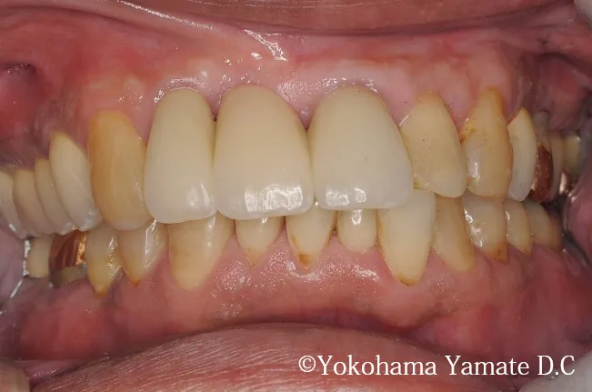 歯肉や骨の再生とインプラント治療術後写真 横浜の歯科・歯医者 横浜山手デンタルクリニック