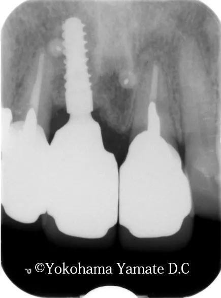 歯肉や骨の再生とインプラント治療術後レントゲン写真 横浜の歯科・歯医者 横浜山手デンタルクリニック