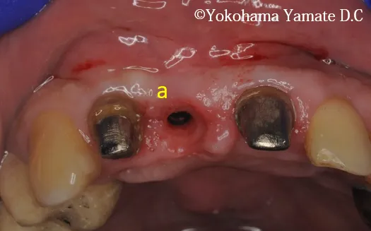 歯肉や骨の再生とインプラント治療 横浜の歯科・歯医者 横浜山手デンタルクリニック