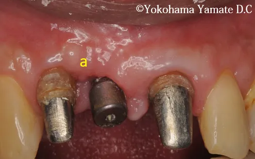 歯肉や骨の再生とインプラント治療 横浜の歯科・歯医者 横浜山手デンタルクリニック