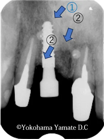 歯肉や骨の再生とインプラント治療 横浜の歯科・歯医者 横浜山手デンタルクリニック